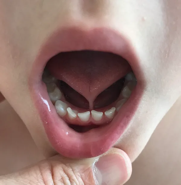 A young child's open mouth with the tongue lifted, showing a thick frenulum that runs to the tongue tip and draws it into a clear heart-shaped notch.