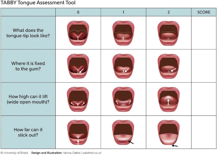 TABBY tongue-tie assessment tool: a four-row grid scoring tongue-tip shape, frenulum attachment point, tongue lift with wide-open mouth, and tongue protrusion. Each row offers three illustrations scoring 0 (most restricted), 1 (intermediate) and 2 (free movement), with a SCORE column on the right.